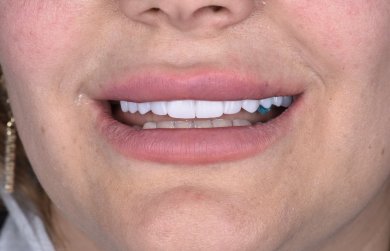 before-after photo dental-implant