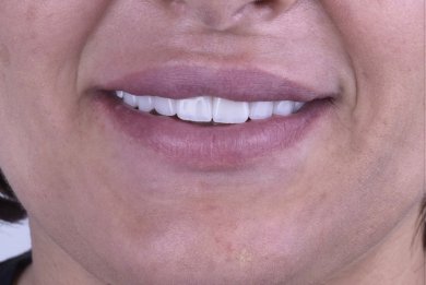 before-after photo dental-implant