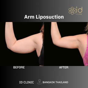 before-after photo vaser-liposuction