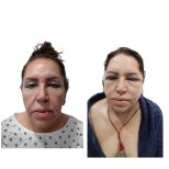 Resultados de minilifting facial antes y después en Hospital de la Familia, rejuvenecimiento facial
