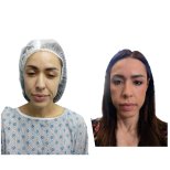 Resultados de minilifting facial antes y después en Hospital de la Familia, rejuvenecimiento
