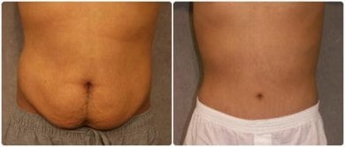 نتائج قبل وبعد جراحة التثدي في Asia Cosmetic Hospital، صدر أكثر تسطحًا