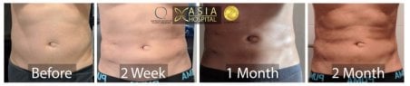 نتائج عملية التثدي قبل وبعد في Asia Cosmetic Hospital – تحديد واضح لمنطقة الصدر