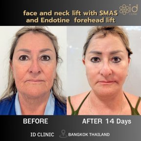 نتائج شد الوجه والرقبة مع SMAS ورفع الجبهة Endotine في ID Clinic Bangkok