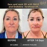 نتائج شد الوجه والرقبة مع SMAS ورفع الجبهة Endotine في ID Clinic Bangkok