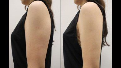 Результат ліпосакції рук рідиною до і після у Forena Clinic, покращення контуру