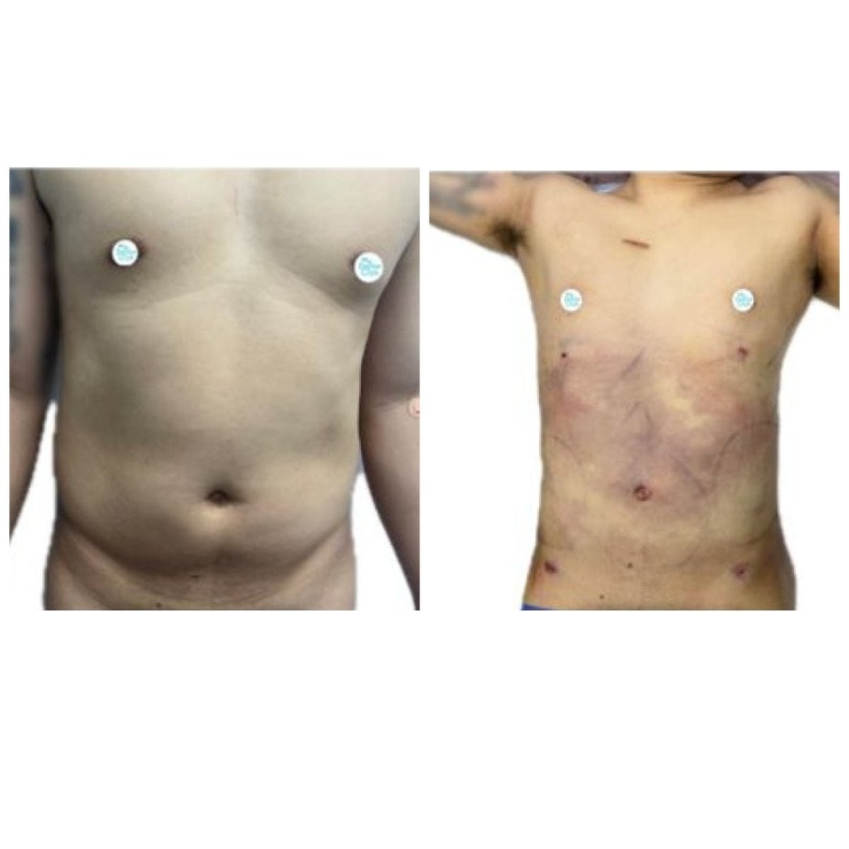 Resultados de liposucción antes y después en Hospital de la Familia, contorno abdominal mejorado