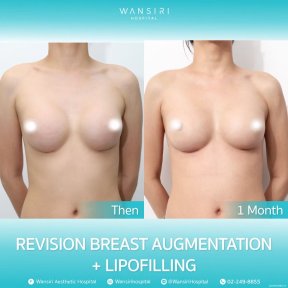 before-after photo lipofilling