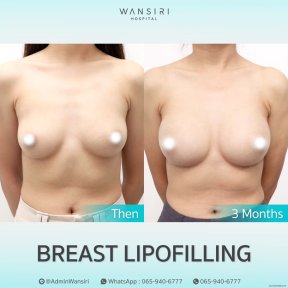 before-after photo lipofilling
