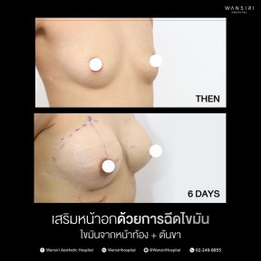before-after photo lipofilling