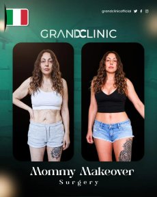 Vorher-nachher-Ergebnisse Mommy Makeover bei Grand Clinic – verbesserte Körperkontur