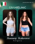 Vorher-nachher-Ergebnisse Mommy Makeover bei Grand Clinic – verbesserte Körperkontur