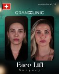 Vorher-nachher-Ergebnisse Facelift bei Grand Clinic, sichtbare Gesichtsverjüngung