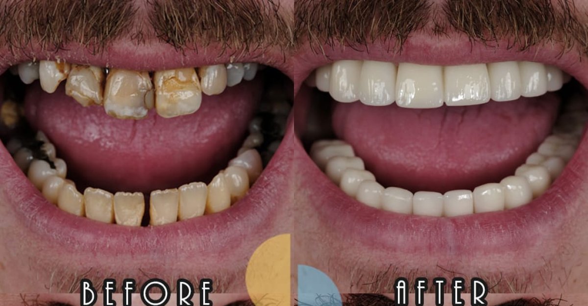Resultado antes y después de prótesis fijas de zirconia sobre 6 implantes de titanio