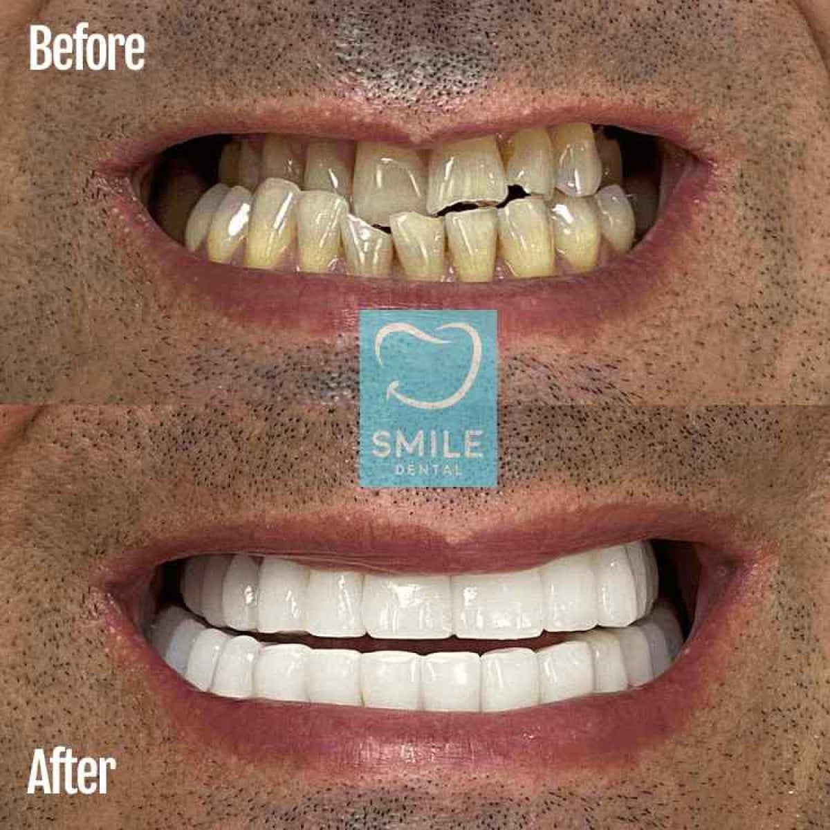 Antes y después de carillas dentales en Smile Dental: resultado de dientes blancos y parejos