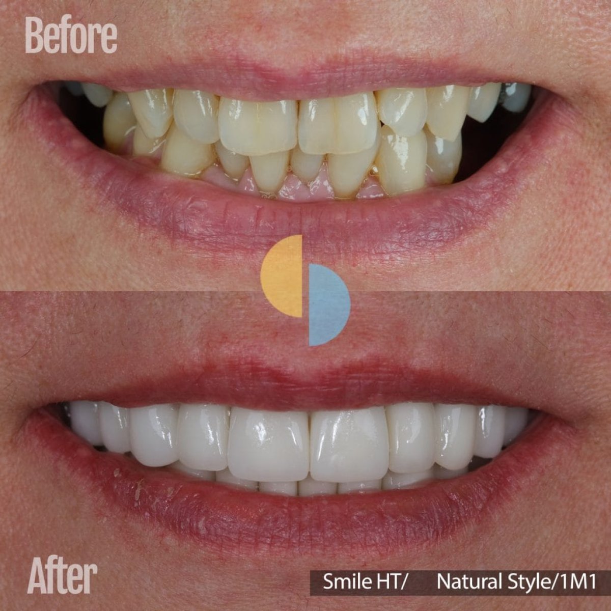 Resultado antes y después de carillas dentales: sonrisa más blanca y natural
