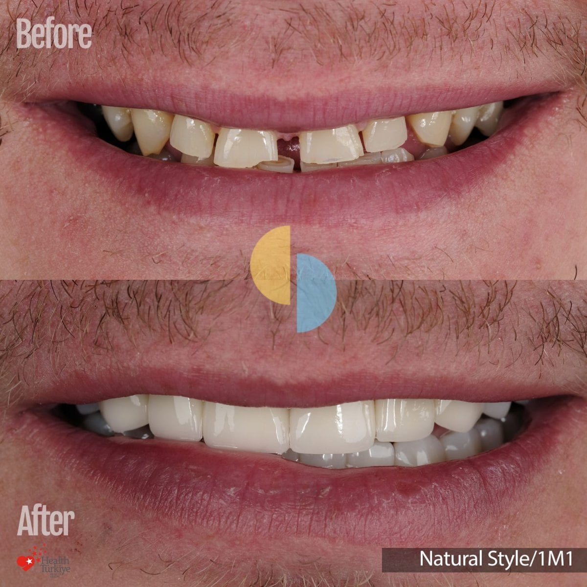 نتائج قبل وبعد تركيب تيجان البورسلين – تحسين جمالية الابتسامة، Natural Style