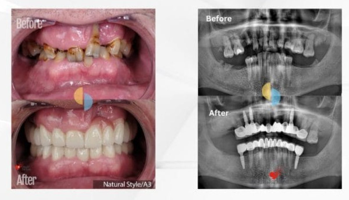 نتائج قبل وبعد زراعة الأسنان مع التاج – ابتسامة مستعادة وصحة فموية محسنة