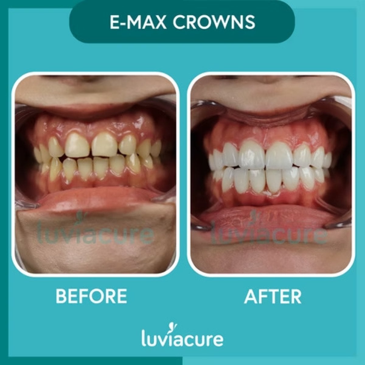 Antes y después de coronas dentales E-max en Luviacure – sonrisa renovada con resultado natural