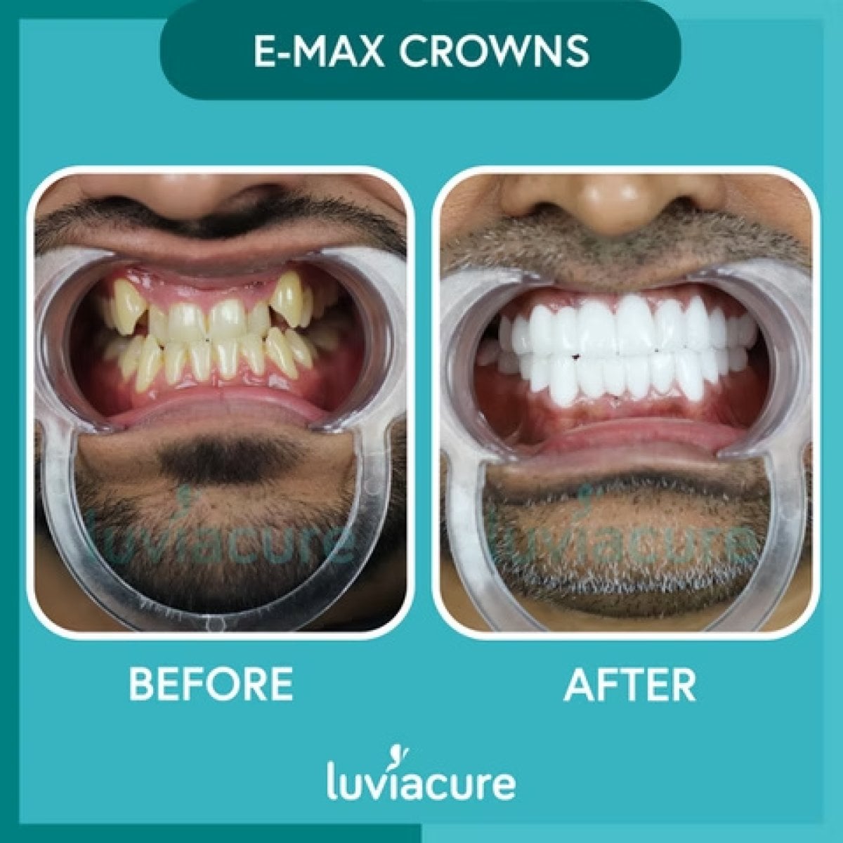 Antes y después de coronas dentales E-max en Luviacure, resultados de transformación de sonrisa