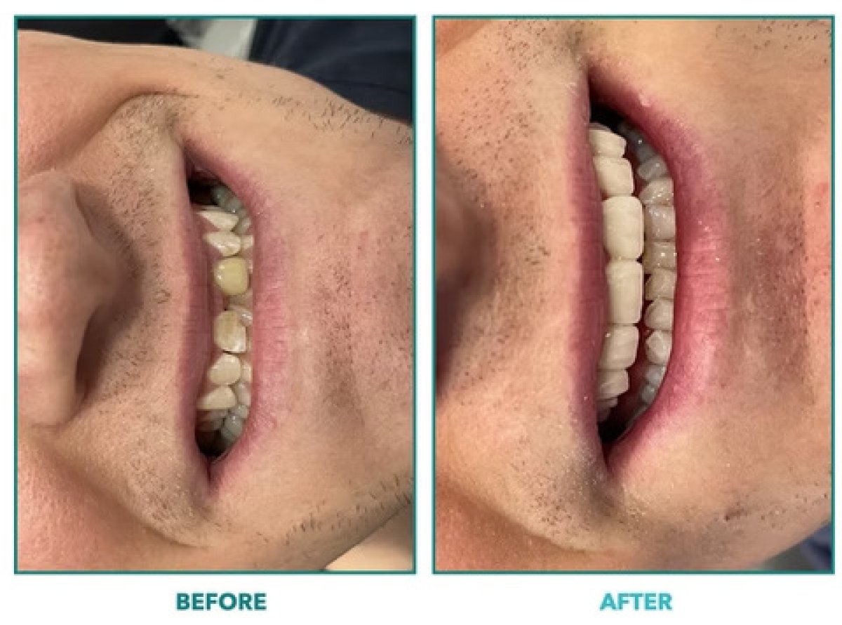 Resultados de blanqueamiento dental antes y después: sonrisa visiblemente más brillante