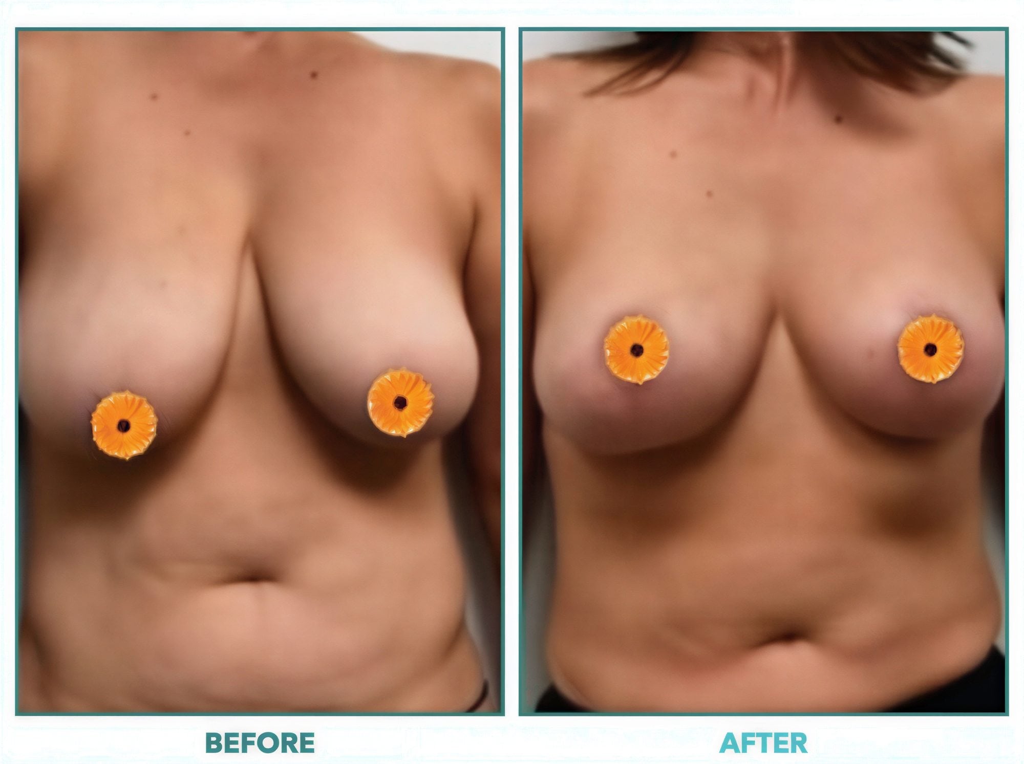 Resultados de lifting de senos antes y después: mejor forma y firmeza mamaria