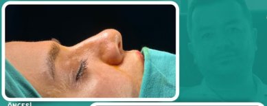 نتيجة قبل عملية تجميل الأنف في العيادة، إعادة تشكيل الأنف لتحسين المظهر