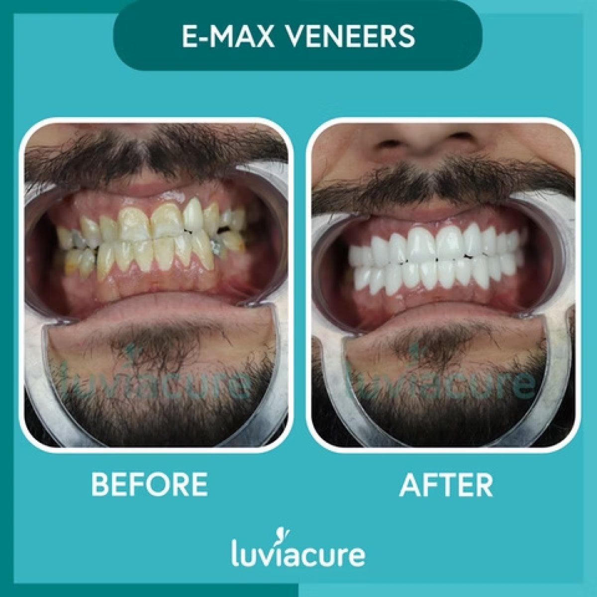 نتائج قبل وبعد فينير E-max في Luviacure – تحول الابتسامة بالفينير