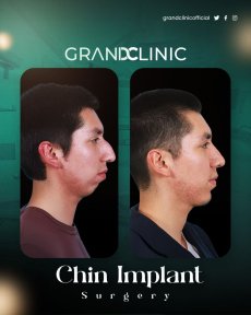 before-after photo chin-implants