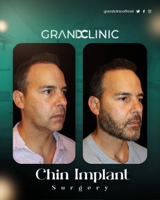 before-after photo chin-implants
