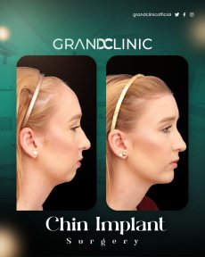 before-after photo chin-implants