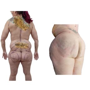 before-after photo liposuction