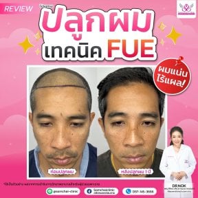 Résultats avant/après greffe de cheveux FUE à la Somchai Clinic – ligne capillaire plus dense après 1 an