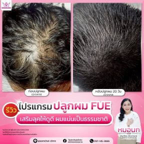 Résultats avant/après greffe de cheveux FUE à la clinique Somchai – densité accrue