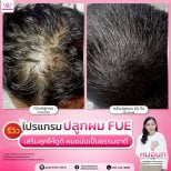 Résultats avant/après greffe de cheveux FUE à la clinique Somchai – densité accrue