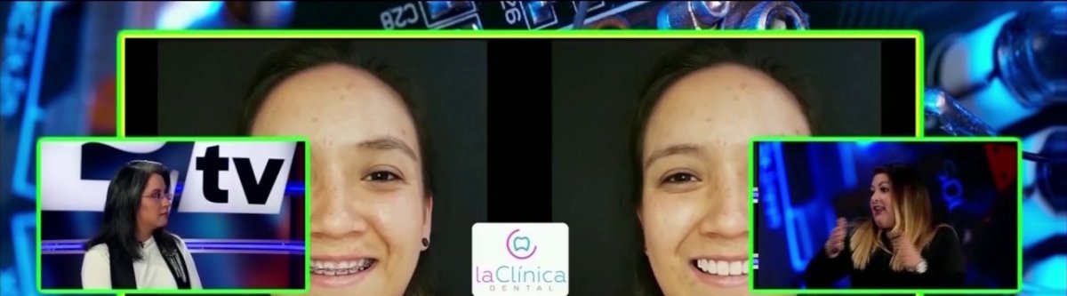 نتائج قبل وبعد تقويم Invisalign في la Clínica Dental – تحسين محاذاة الابتسامة