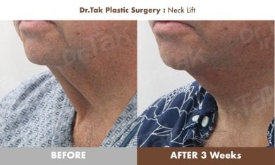 before-after photo deep-plane-facelift