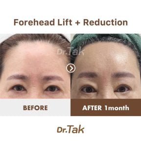 before-after photo deep-plane-facelift