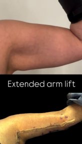 before-after photo arms-plastics-brachioplasty
