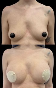 before-after photo liposuction