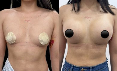 before-after photo liposuction