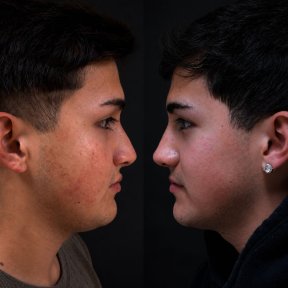 before-after photo rhinoplasty-nose-job