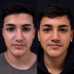 before-after photo rhinoplasty-nose-job