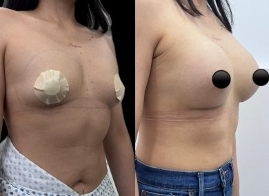 before-after photo breast-augmentation