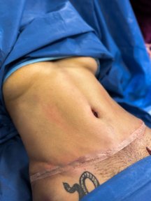 before-after photo liposuction