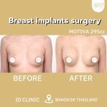 Resultados antes y después de aumento de senos en ID Clinic Bangkok con implantes Motiva 295cc