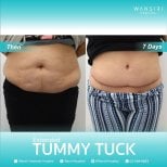 Resultados antes y después de abdominoplastia extendida en Wansiri Hospital, abdomen más plano