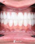 Résultat implants dentaires All-on-4 chez Soraca Med – arcade complète au rendu naturel