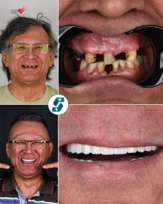 Résultats avant/après implants All-on-4 chez Soraca Med – restauration complète du sourire