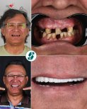 Résultats avant/après implants All-on-4 chez Soraca Med – restauration complète du sourire